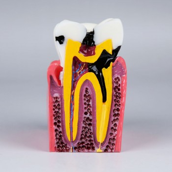 M4021 Caries model compares healthy and caries tooth