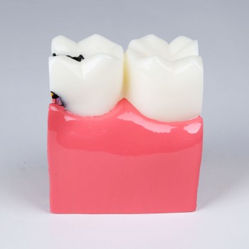 M4021 Caries model compares healthy and caries tooth